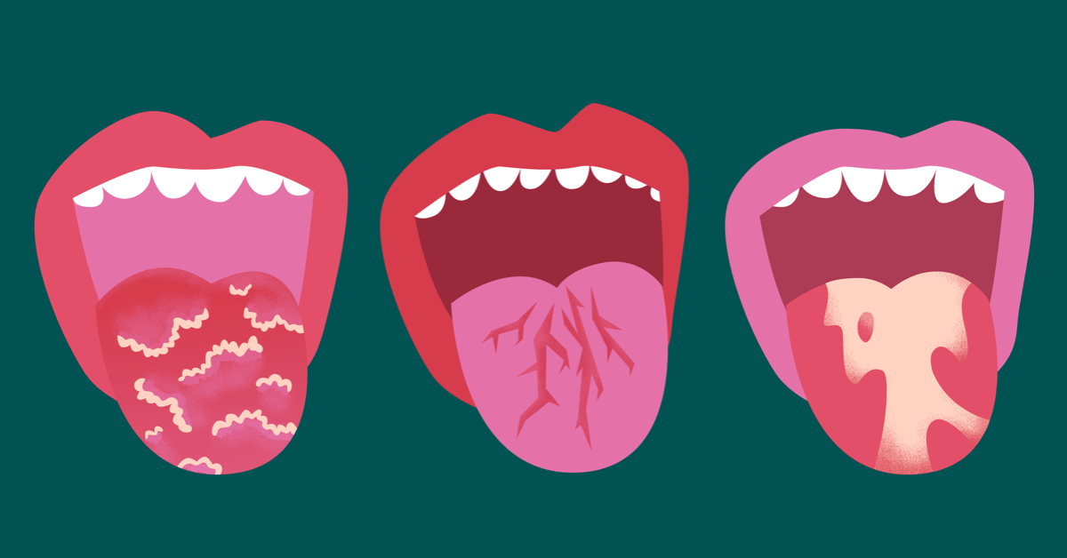 como-identificar-os-sinais-de-colite-ulcerativa-no-atendimento